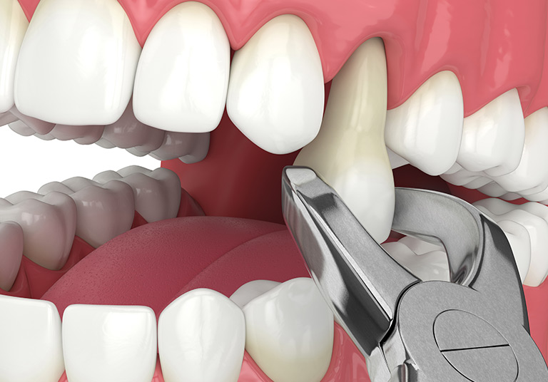Determining Eligibility For The Tooth Extraction Procedure